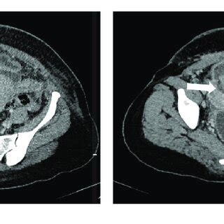 Computed Tomography Demonstrating A Fluid Collection Anterior To The