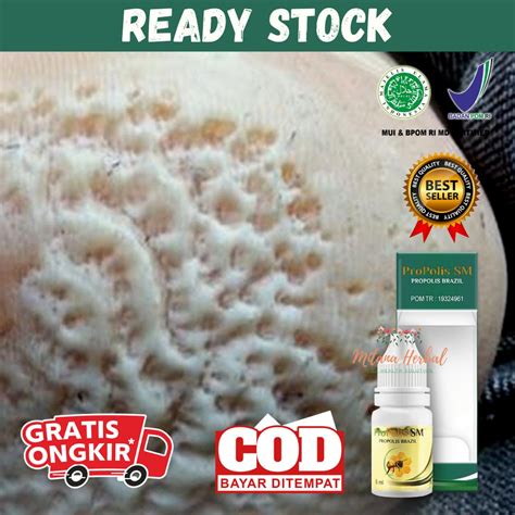 Jual Obat Kaki Rayapan Dan Bau Obat Kaki Rayapan Kronis Obat Kaki