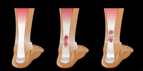 Know More About Bone Marrow Cancer