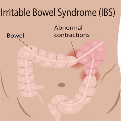 Irritable bowel syndrome | Download Scientific Diagram