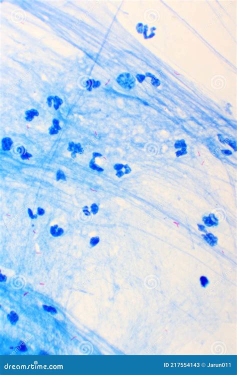 Mycobacterium Tuberculosis Positive Small Red Rod In Sputum Smear Stock