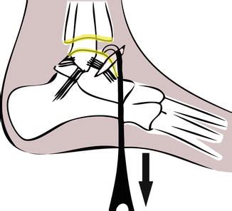 Arthroscopic Ankle Arthrodesis | Musculoskeletal Key