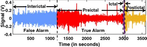 A Typical 1 Hour Epileptic Eeg Recording Showing Various States