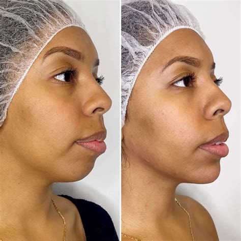 Chinfix Filler Beautyfix Medspa 212 366 4787