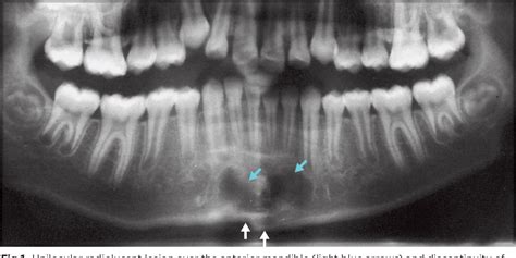 Traumatic Bone Cyst