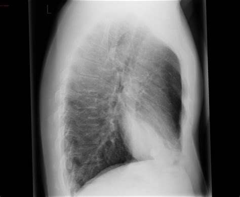 Pneumonia Right Middle Lobe Image