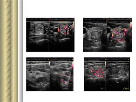 Pdf Citolog A Tiroidea Lesion Folicular Endosuem Org Uy Wp Content