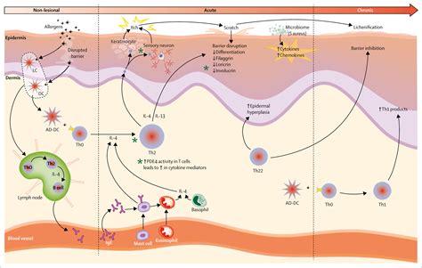 Irritant Contact Dermatitis Pathophysiology