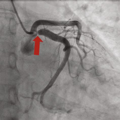 (a and b) Coronary CT angiography demonstrating proximal left ...