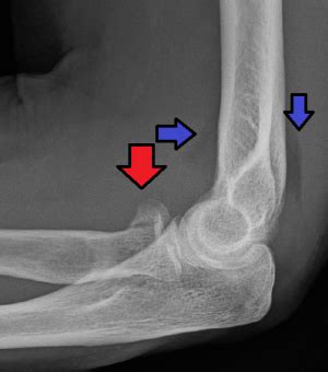 Radial head fracture - WikEM