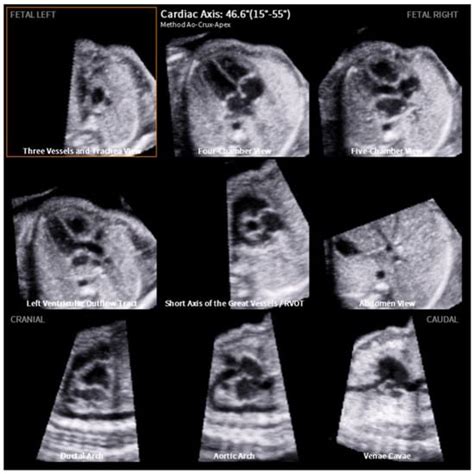 Jcm Free Full Text Semi Automatic Measurement Of Fetal Cardiac Axis