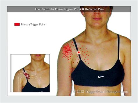 Pectoralis Minor Trigger Point: The Annoying Little Brother ...