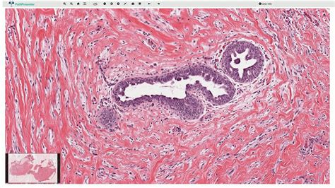 Gynecomastia Histopathology Youtube