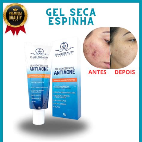 Pomada Que Seca Espinha - Gel Creme Seca Espinha Antiacne PhalleBeauty Eficácia Completa | Shopee ...
