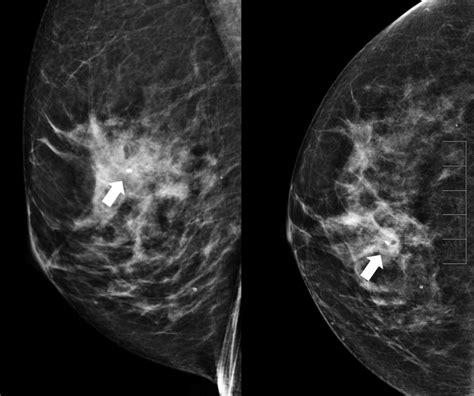 How To Perform Stereotactic Mammographic Guided Biopsy Radiology Ucla Health