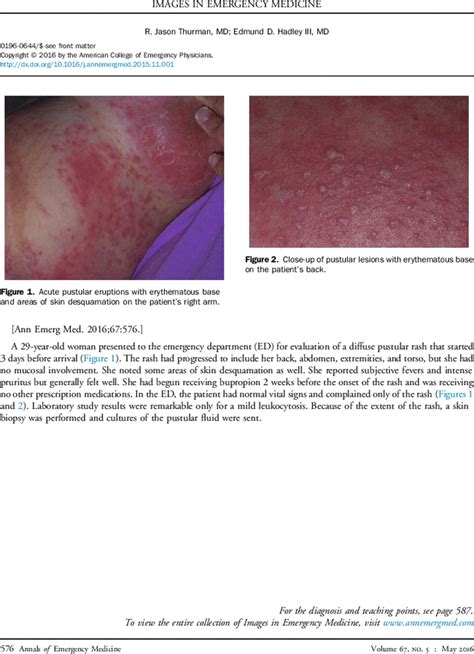 Young Woman With Diffuse Pustular Rash Annals Of Emergency Medicine