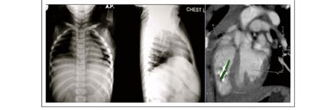 Chest X Ray A And Computed Tomography Scan Of Chest B Showing The