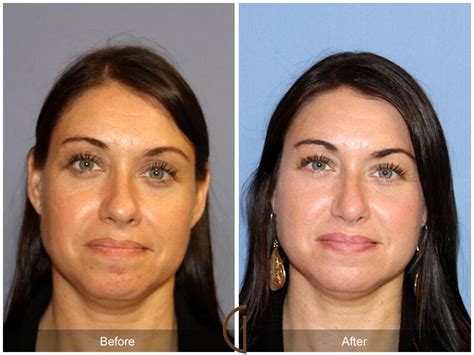 Tip Rhinoplasty Before After Photos From Dr Kevin Sadati