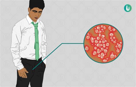 Genital Warts Symptoms Causes Treatment Medicine Prevention Diagnosis