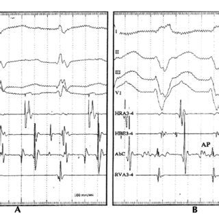 Change Of Qrs Morphology During Rapid Atrial Pacing The Qrs Complex