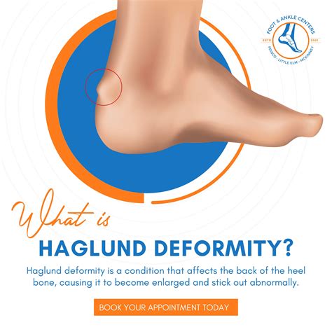 🦶 Haglund deformity is a condition that affects the back of the heel