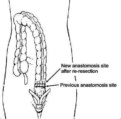 Postoperative Schema For Recurred Rectal Cancer After Low Anterior