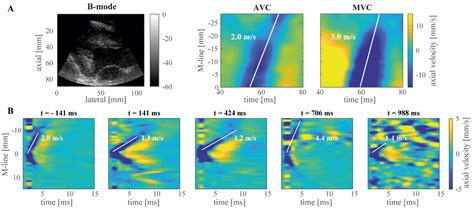 Cardiac And Arterial Shear Wave Elastography Institute Of Biomedical