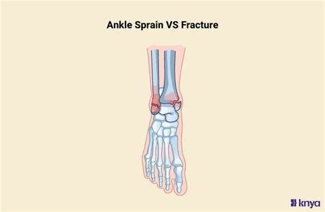 Sprained Vs Broken Ankle Know The Difference And Find Relief Fast Knya