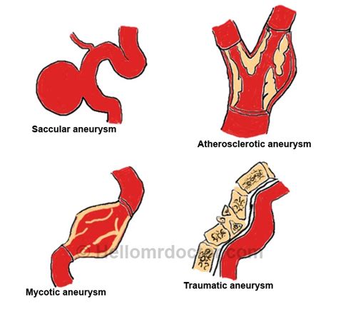 Mycotic Aneurysm Pathology Diagnosis Treatment Complications