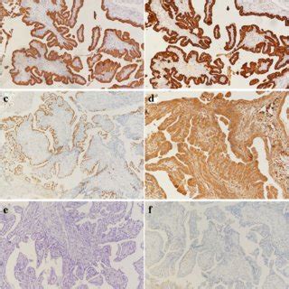 Immunohistochemical Staining Of ELST The Tumor Cells Showed Positive