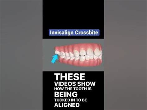 Crossbite Fixed with Invisalign - YouTube