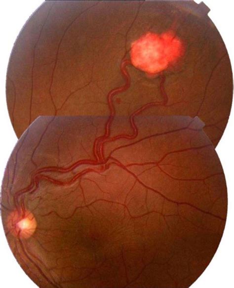 Retinal Capillary Haemangioma Health Medicine And Anatomy Reference Pictures Anatomy