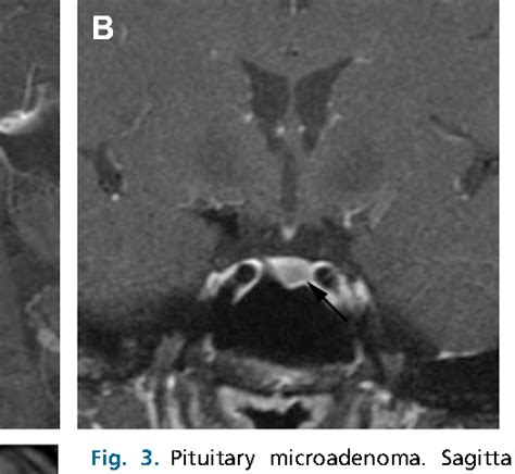 Figure From Imaging Of The Sella And Parasellar Region Semantic