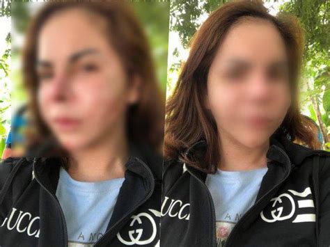 Sau biến chứng nạo silicone hot girl chuyển giới triệu followers tiếp tục khoe ảnh sửa mũi