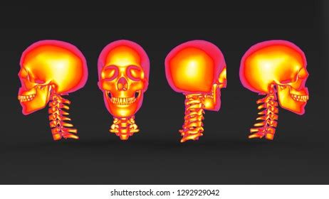 Mri Brain Cerebrovascular Disease Hemorrhagic Stroke Stock Illustration 1292929042 | Shutterstock