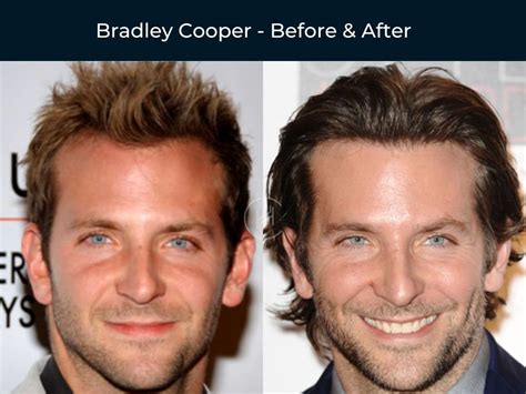 Bradley Cooper Hair Transplant Before After Bradley Cooper Hair