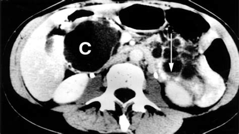 Cyst: Types, Treatments, and Prevention