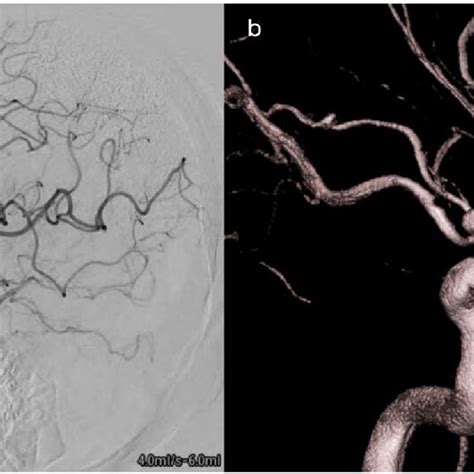 Angiography A And 3DRA B Of The Left ICA Showing A Ruptured De Novo