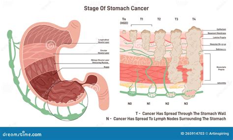 Stades Du Cancer De L Estomac Croissance Des Cellules Malignes