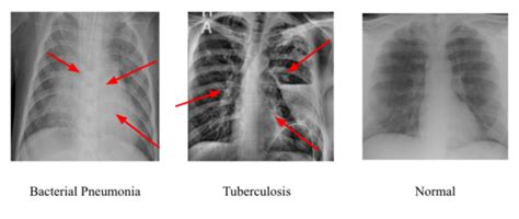 Tuberculosis Lung X Ray