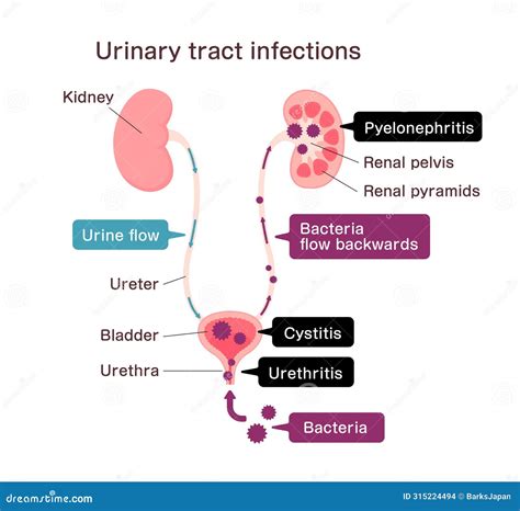 Urinary Tract Infection Or UTI Treatment For Bladder Illness Outline