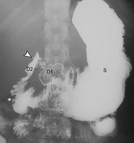 Fluoroscopic Evaluation Of Duodenal Diseases Radiographics