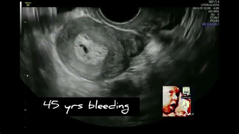 Cystic Endometrial Hyperplasia Ultrasound By Dr Haissam Aref DMS MSc