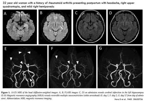 Reversible Cerebral Vasoconstriction Syndrome Rcvs Emcrit Project