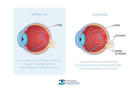 What Is Usually The First Sign Of Glaucoma Comprehensive Guide