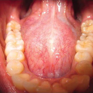 Floor Of Mouth Dermoid Cyst Viewfloor Co