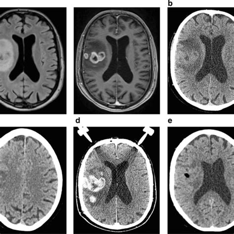 Patient was admitted with suspected cerebral vasculitis. MRI showed ...