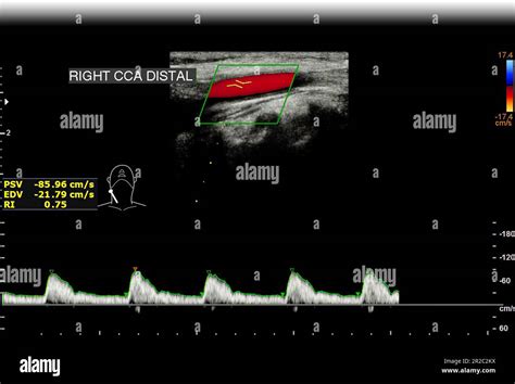 A carotid artery Doppler ultrasound is a diagnostic test used to check ...