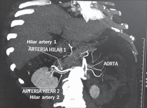 Scielo Brasil Multidetector Computed Tomography Angiography Of The