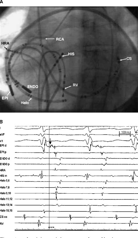 Figure 1 From NASPE 25 TH ANNIVERSARY SERIES Catheter Ablation Of